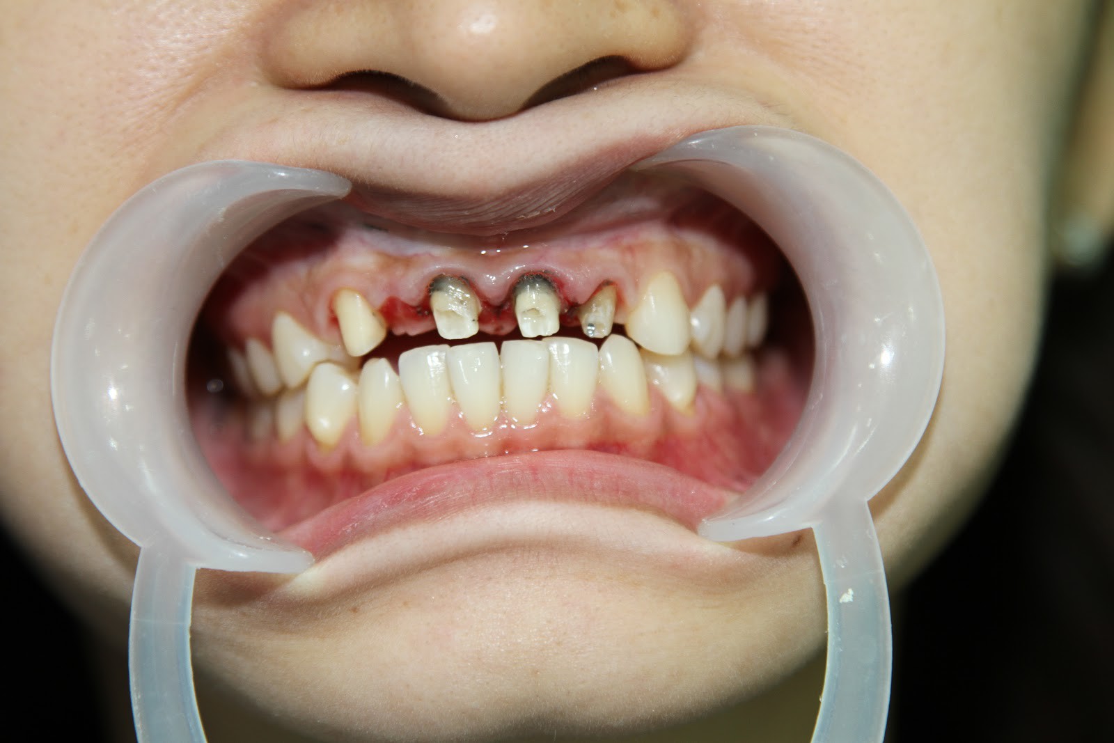 Bọc răng sứ không đảm bảo chất lượng, bạn phải đối mặt với những nguy cơ nào?
