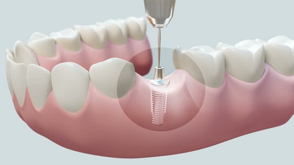 Cấy ghép răng Implant - Phương pháp trồng răng bền vững, đảm bảo sức khỏe