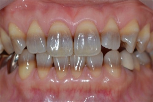4 trường hợp nhất định không được tẩy trắng răng