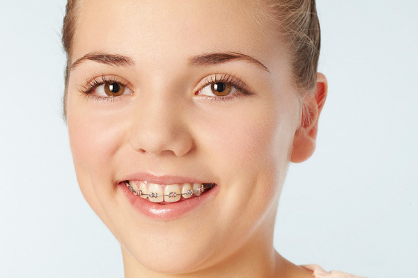 Cẩm nang đặc biệt giúp bạn tự tin khi niềng răng