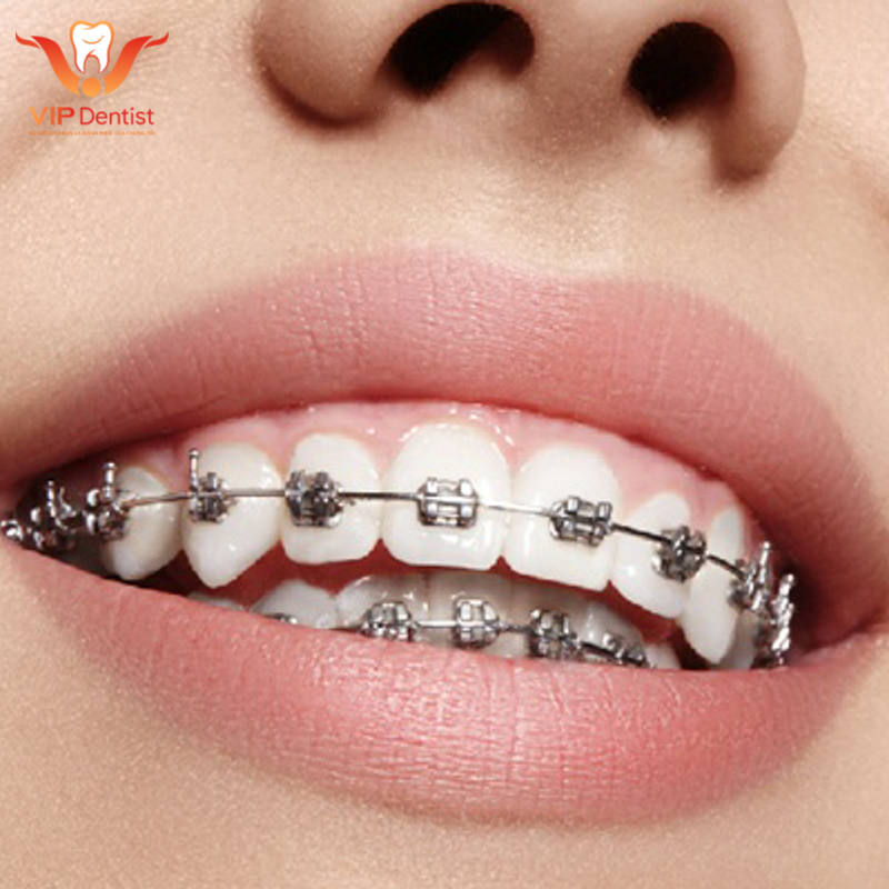 Niềng răng lệch lạc - giải pháp hiệu quả điều trị răng lộn xộn