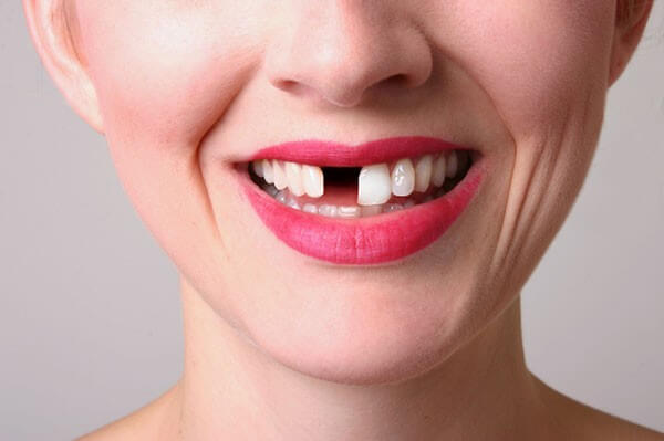 Nguyên nhân và hậu quả của mất răng là gì?